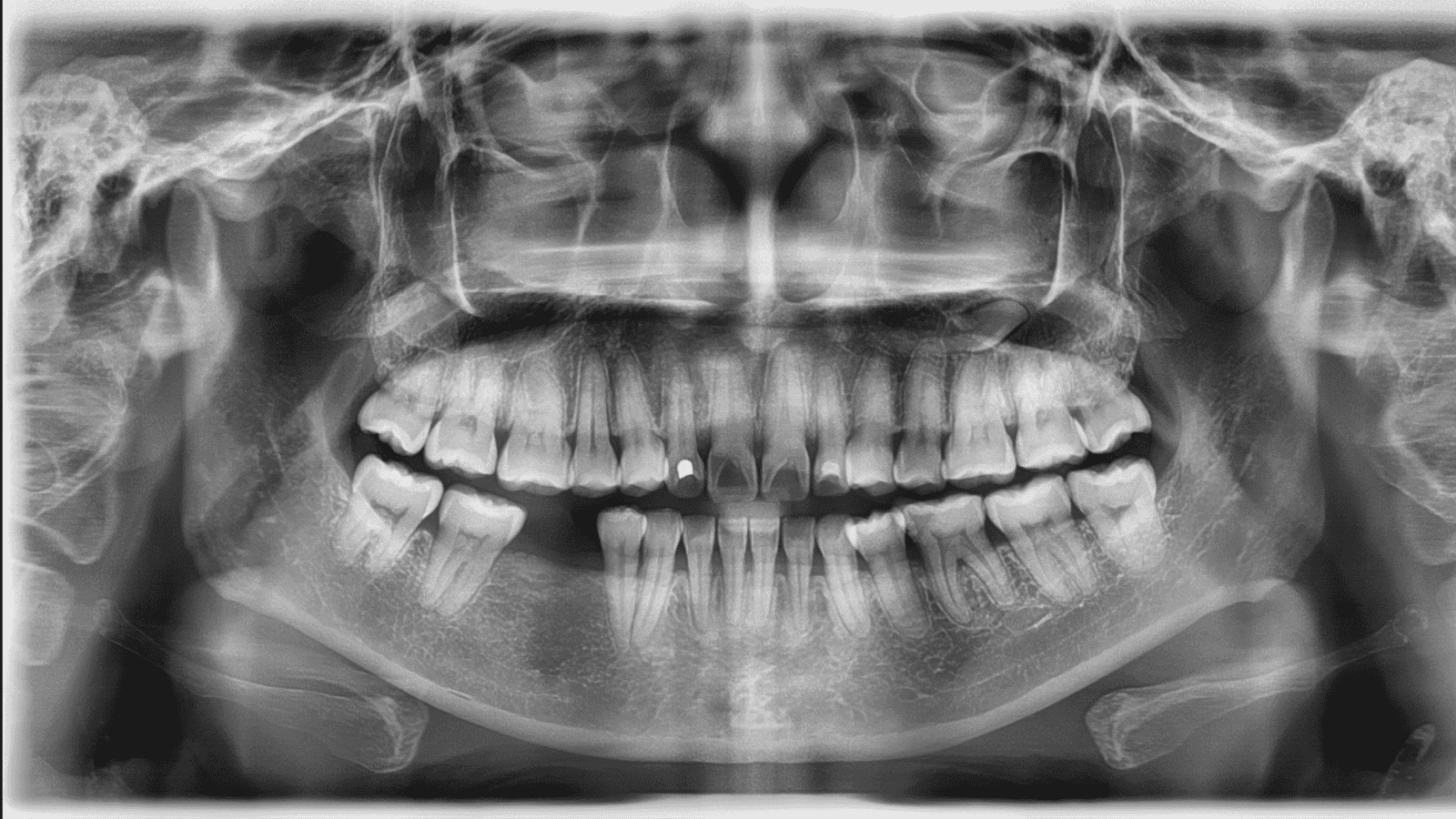 What is a Panoramic X-ray?