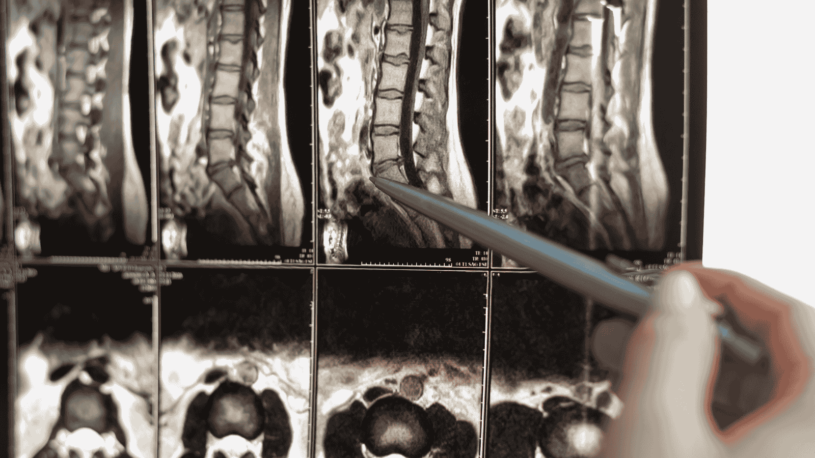 Lomber Tomografi Nedir?
