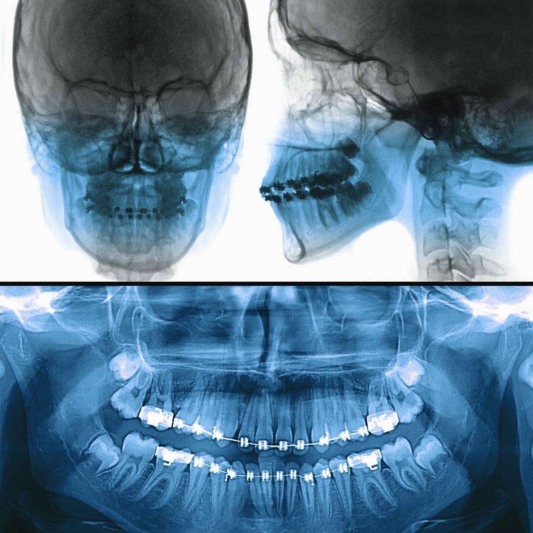 Cephalometric X-Ray